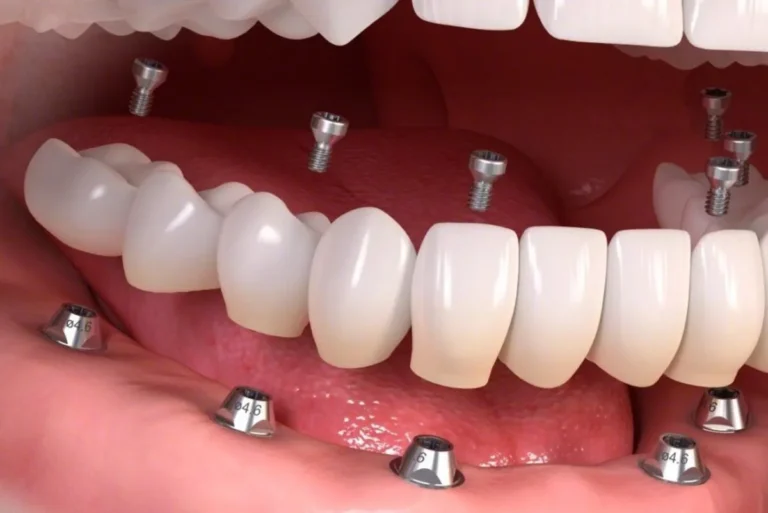 dental-implant-3